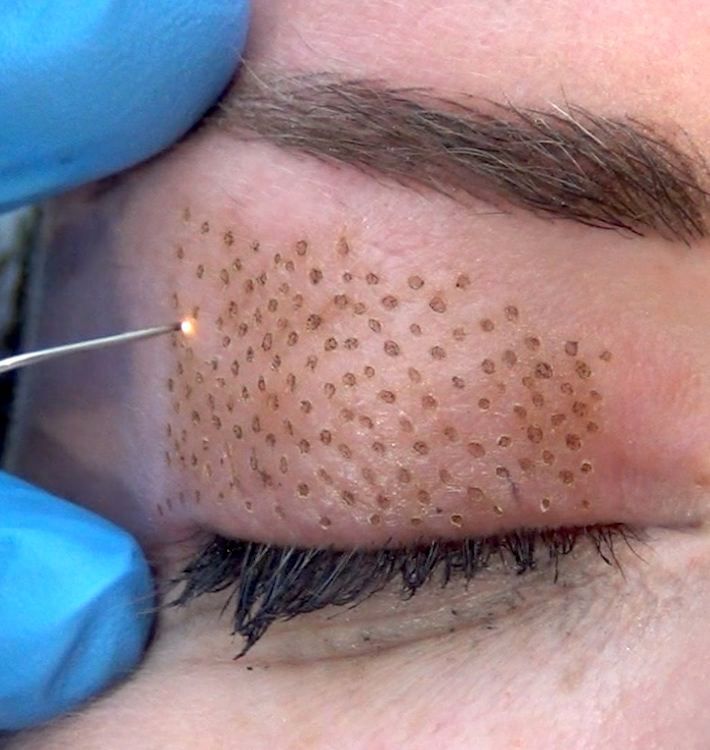 Permanent Makeup, HIFU, Facial, Skin, Acne, Blemish Removal, Laser Hair Removal, Clinic, Norwich