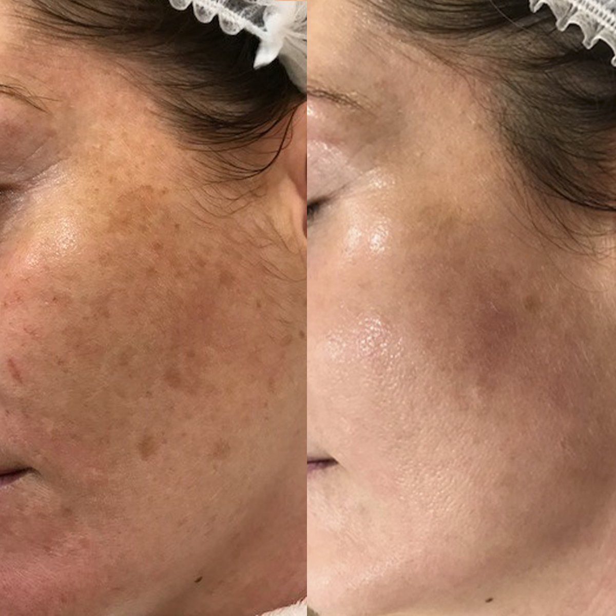 IPL skin treatment in Norwich