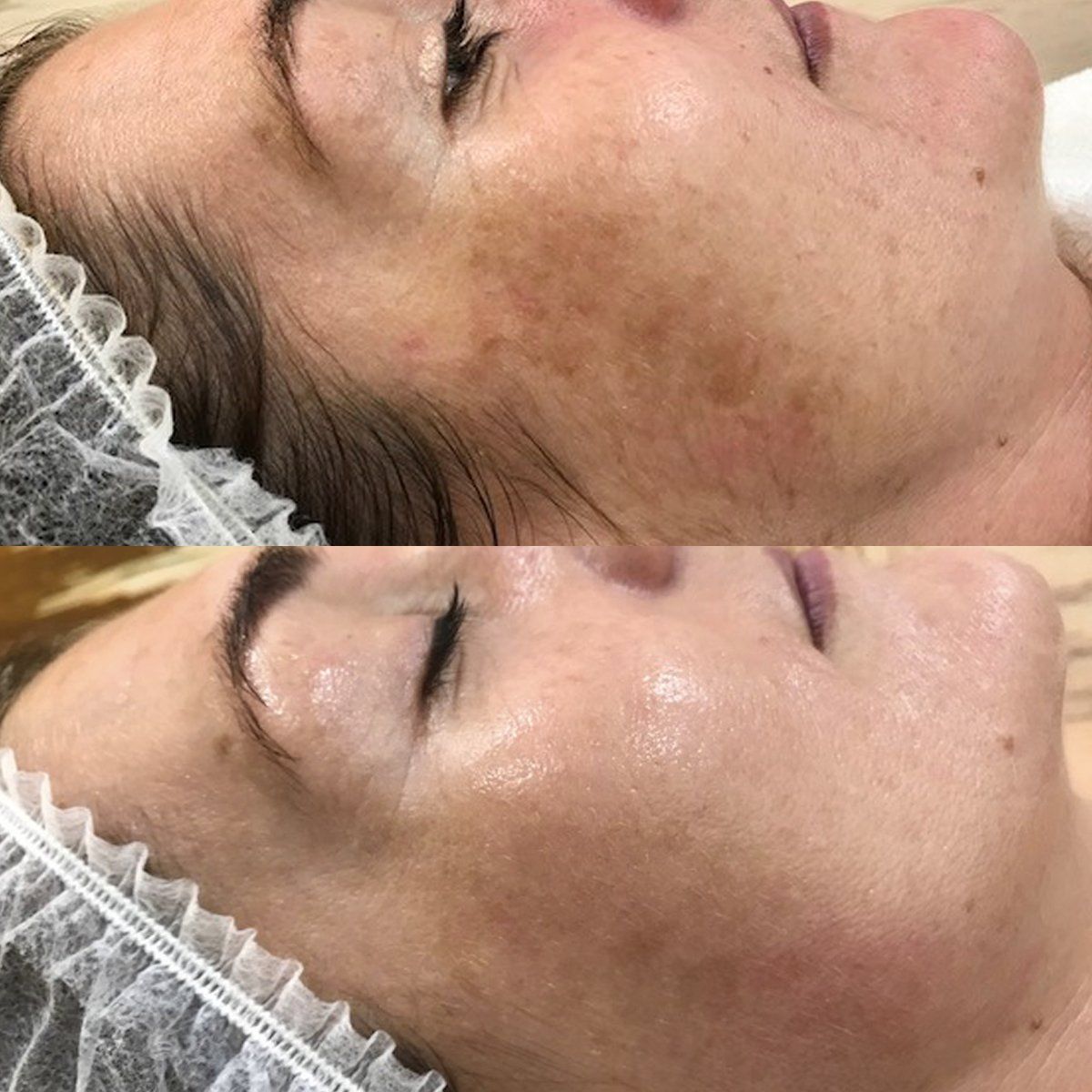 Permanent Makeup, HIFU, Facial, Skin, Acne, Blemish Removal, Laser Hair Removal, Clinic, Norwich