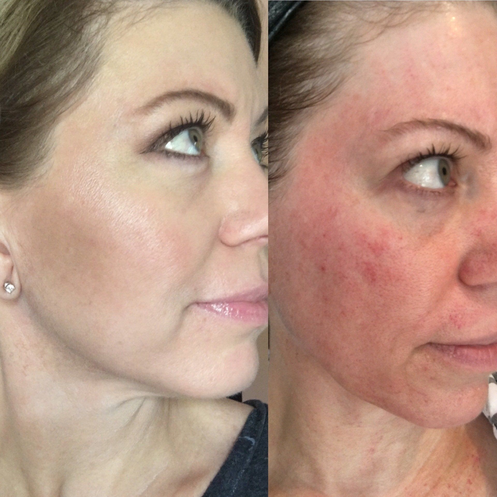 Microneedling treatment in Norwich