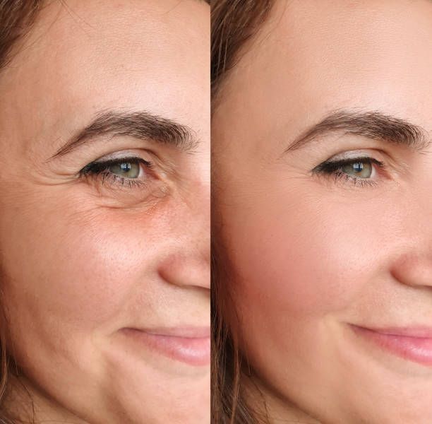 Permanent Makeup, HIFU, Facial, Skin, Acne, Blemish Removal, Laser Hair Removal, Clinic, Norwich