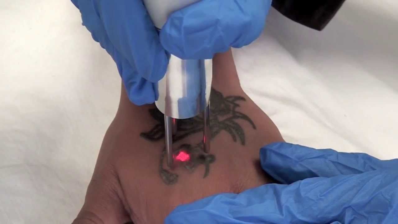 Laser tattoo removal,High Grade House Norwich