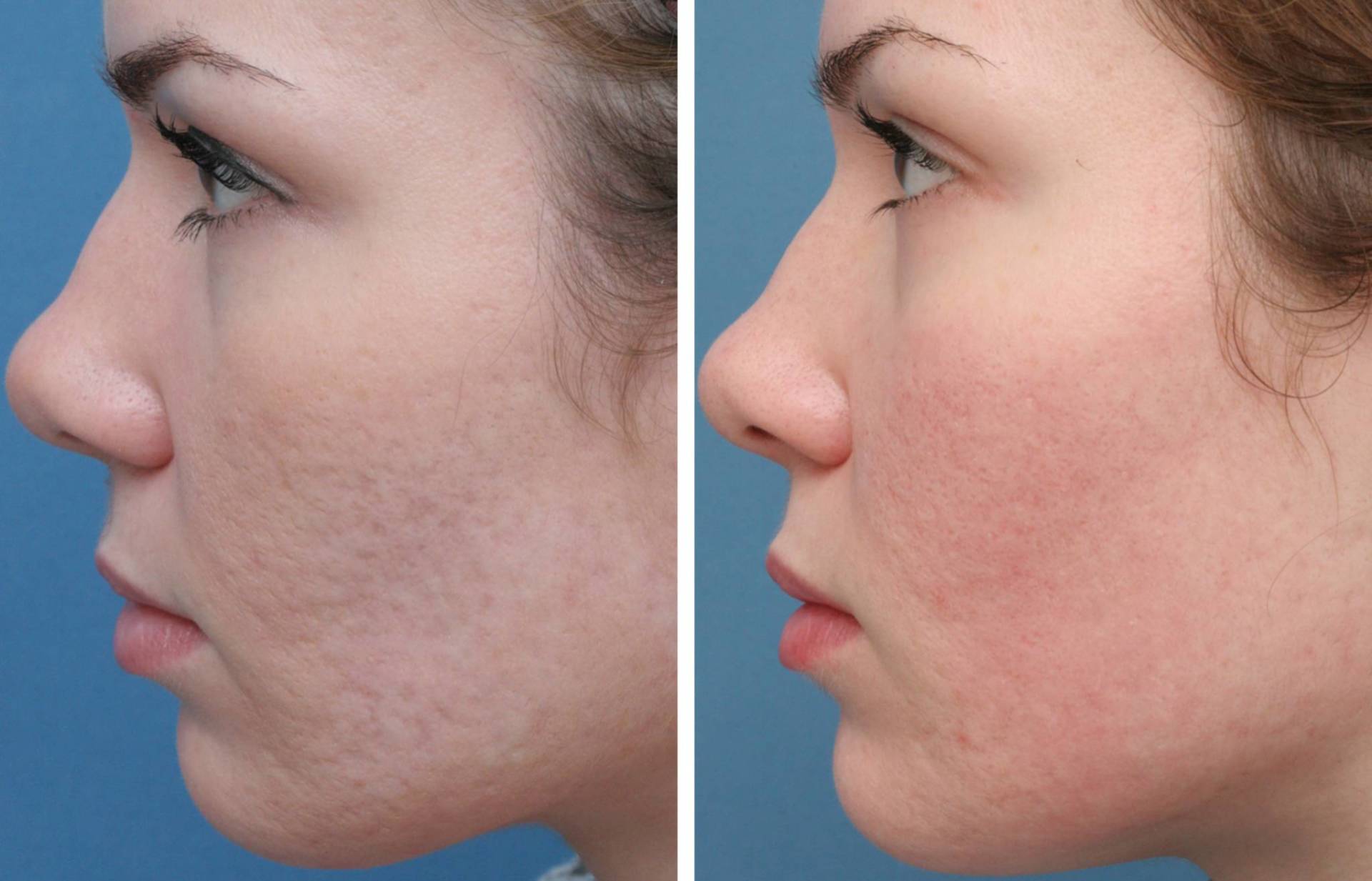 IPL skin treatment in Norwich
