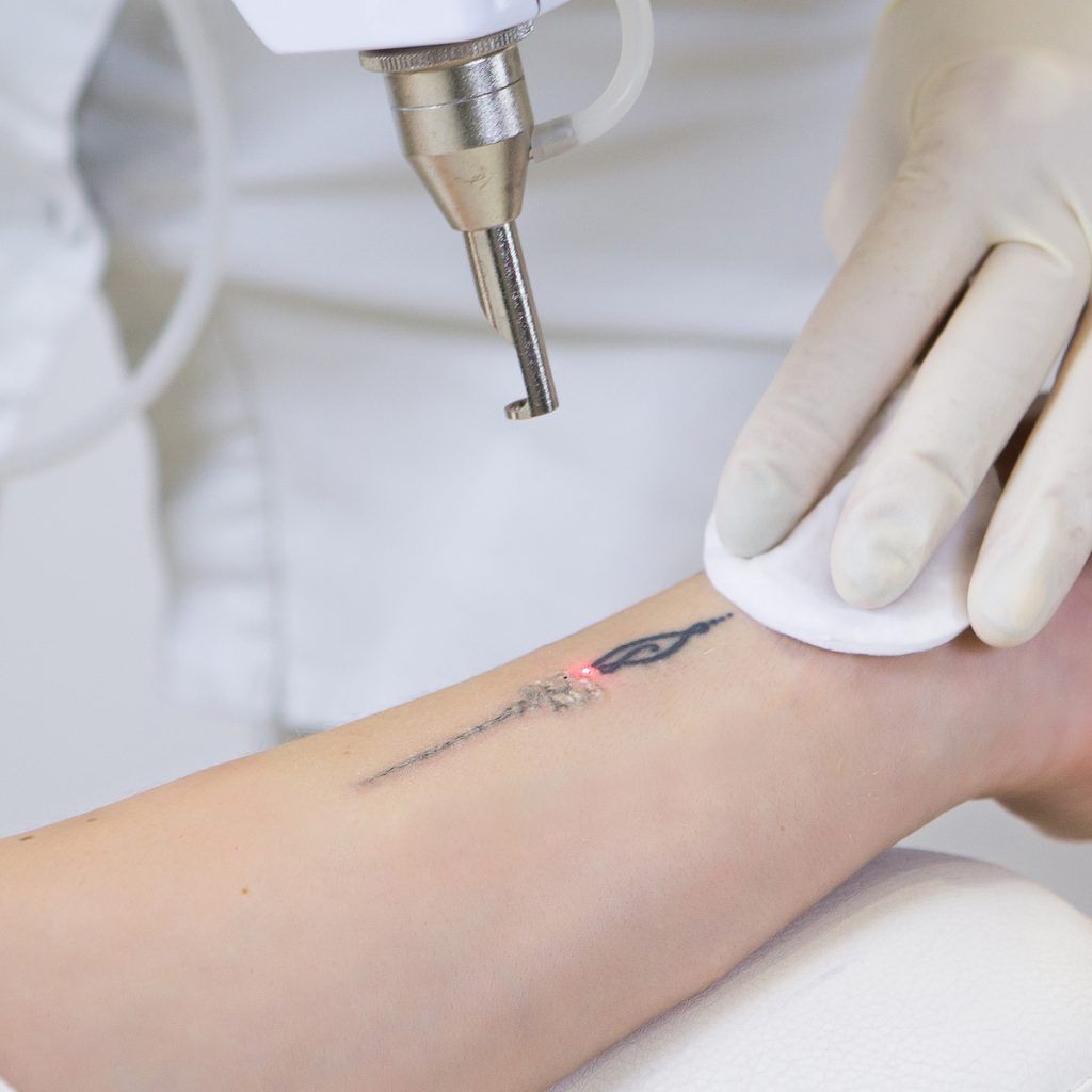 Laser tattoo removal treatment in Norwich