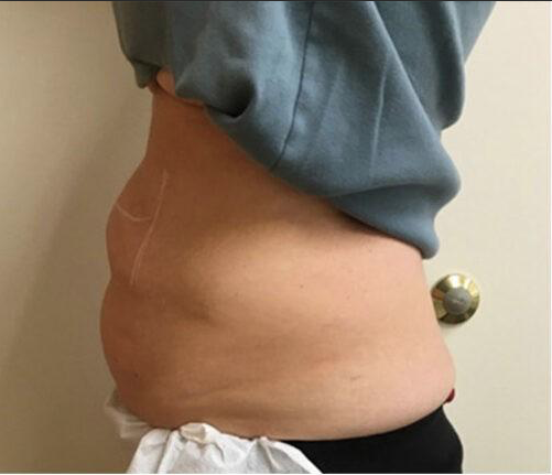 Permanent Makeup, HIFU, Facial, Skin, Acne, Blemish Removal, Laser Hair Removal, Clinic, Norwich
