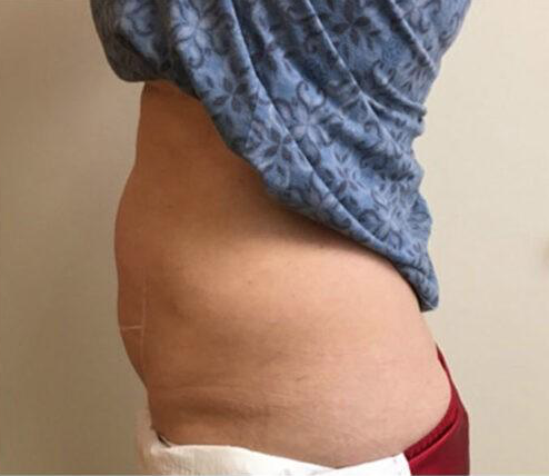 Permanent Makeup, HIFU, Facial, Skin, Acne, Blemish Removal, Laser Hair Removal, Clinic, Norwich