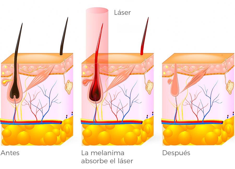 esquema laser diodo