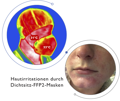RKI: Dichtigkeit der FFP2 verursacht Gesichtsdermatitis RKI: Dichtigkeit der FFP2 verursacht Gesichtsdermatitis