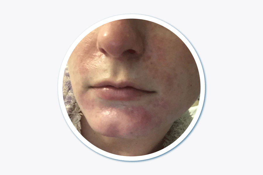 Eine FFP2 Maske kann laut RKI „ zu Atembeschwerden oder Gesichtsdermatitis infolge des Dichtsitzes führen“ Der Arbeitgeber sollte darauf achten dass die Schutzausrüstung zu keinen gesundheitlichen Schäden führt. FFP2 kann Hautirritationen verursachen