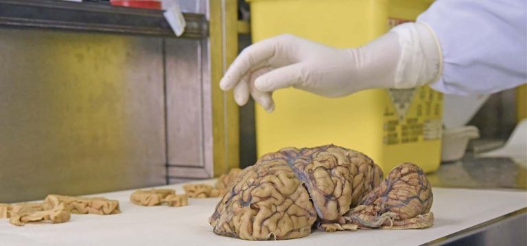 cerebro humano en la mesa de operaciones Cerebro en la mesa de operaciones