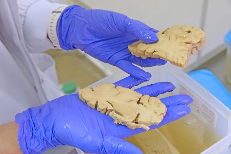 Mostrando un corte de cerebro humano Cortes de cerebro humano