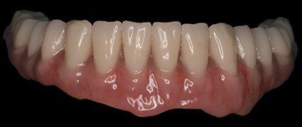 Prótesis dental