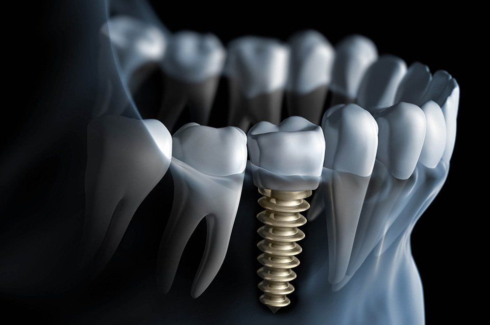 Implantología dental