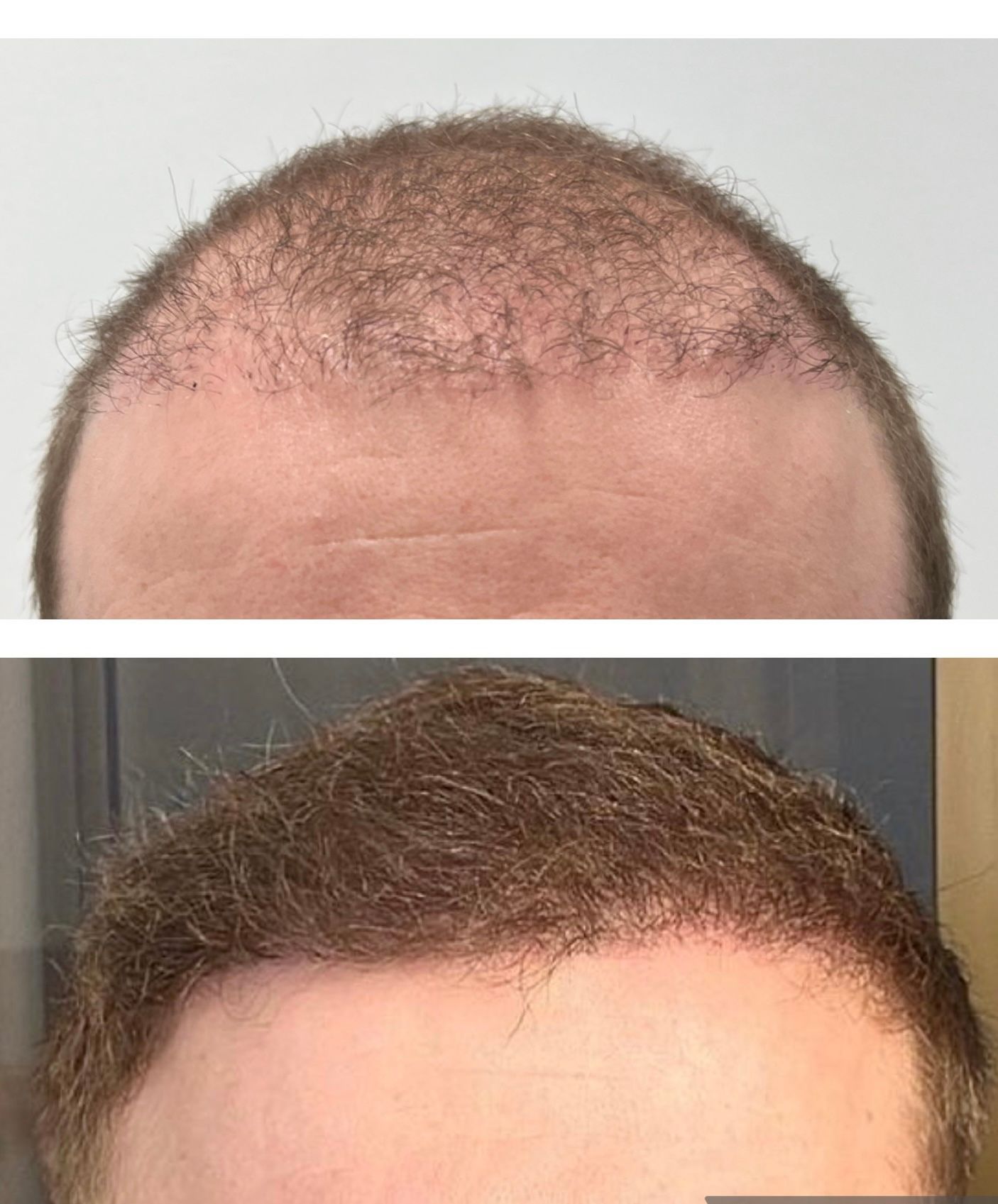 Before and after hair transplant with prp
