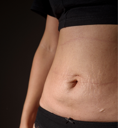 Narbenbehandlung nach der Geburt