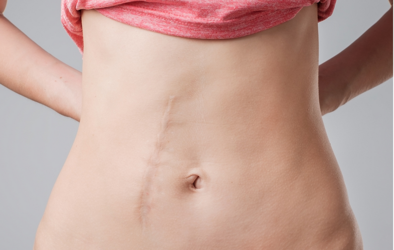 Narbenschmerzen nach einer Operation