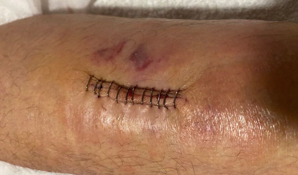 Estado de la herida, tras la primera cura.