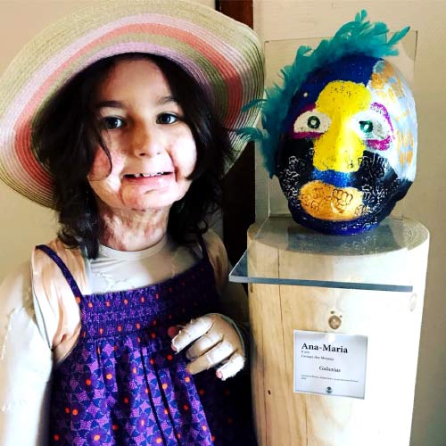 Ana Maria - Child Burn Survivors