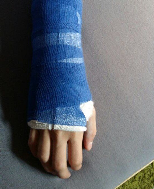 Armbruch Armbruch