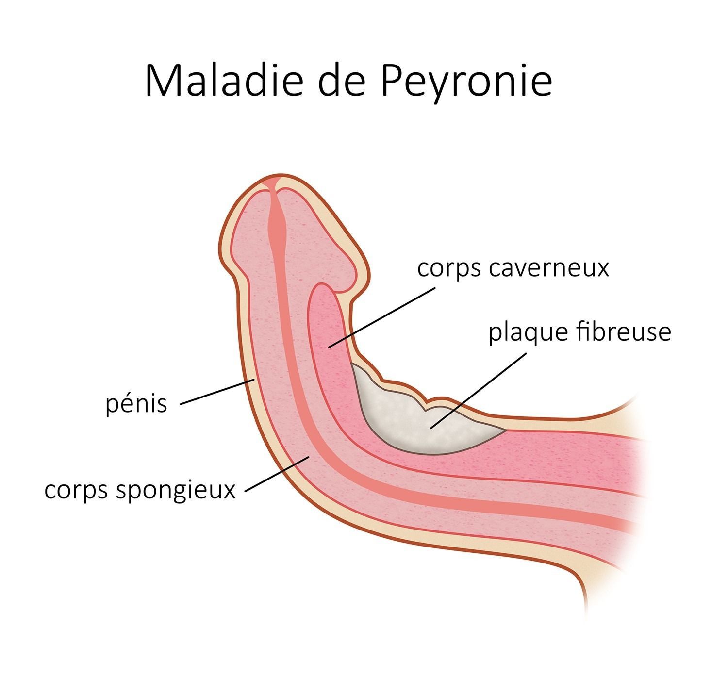 maladie de Peyronie maladie de Peyronie