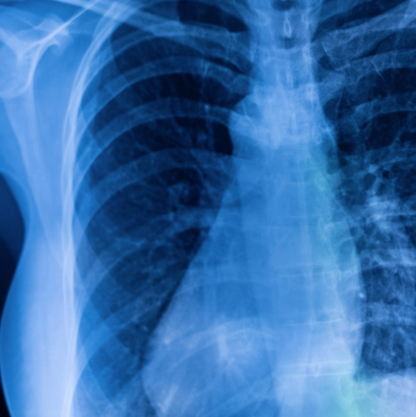 Lungs X Ray Emergency Room