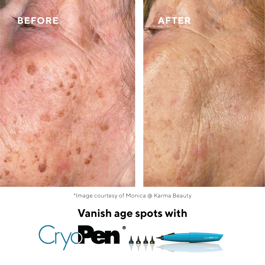 CryoPen Cryotherapy at Spa Bottom Treatment Rooms near Harrogate and Wetherby