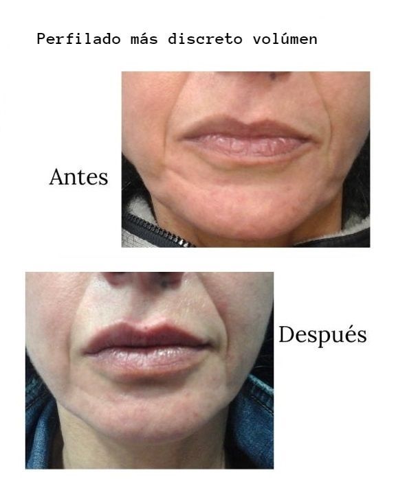aumento labio con acido hialuronico