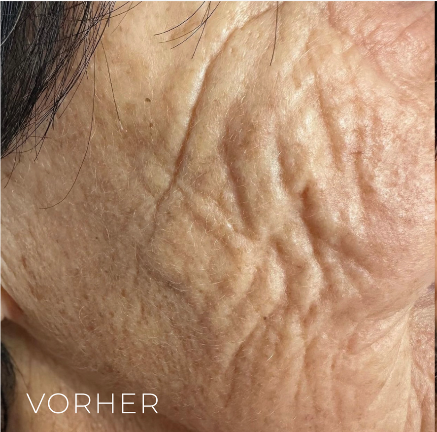 Vorher