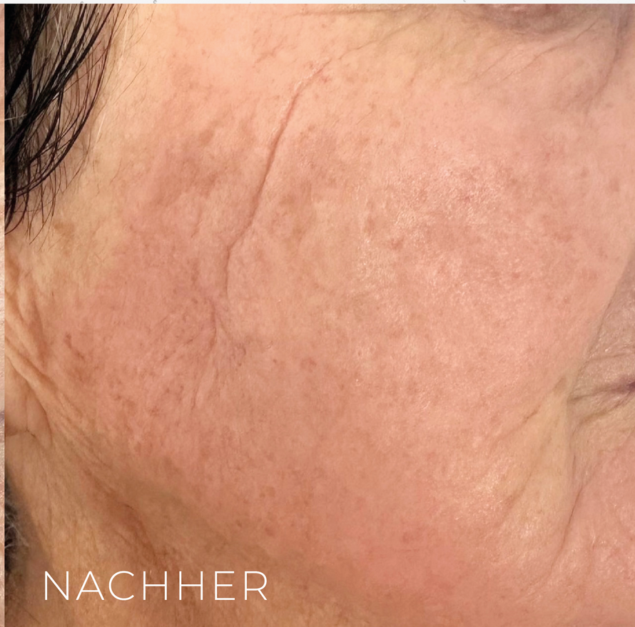 Nachher