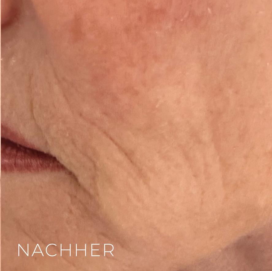 Nachher