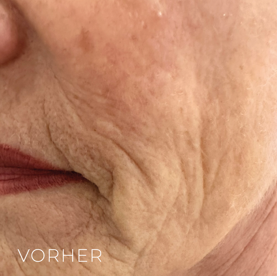 Vorher