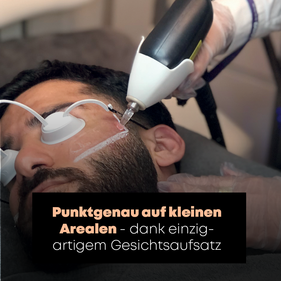 Dauerhafte Laser Haarentfernung Gesicht Dauerhafte Laser Haarentfernung Gesicht