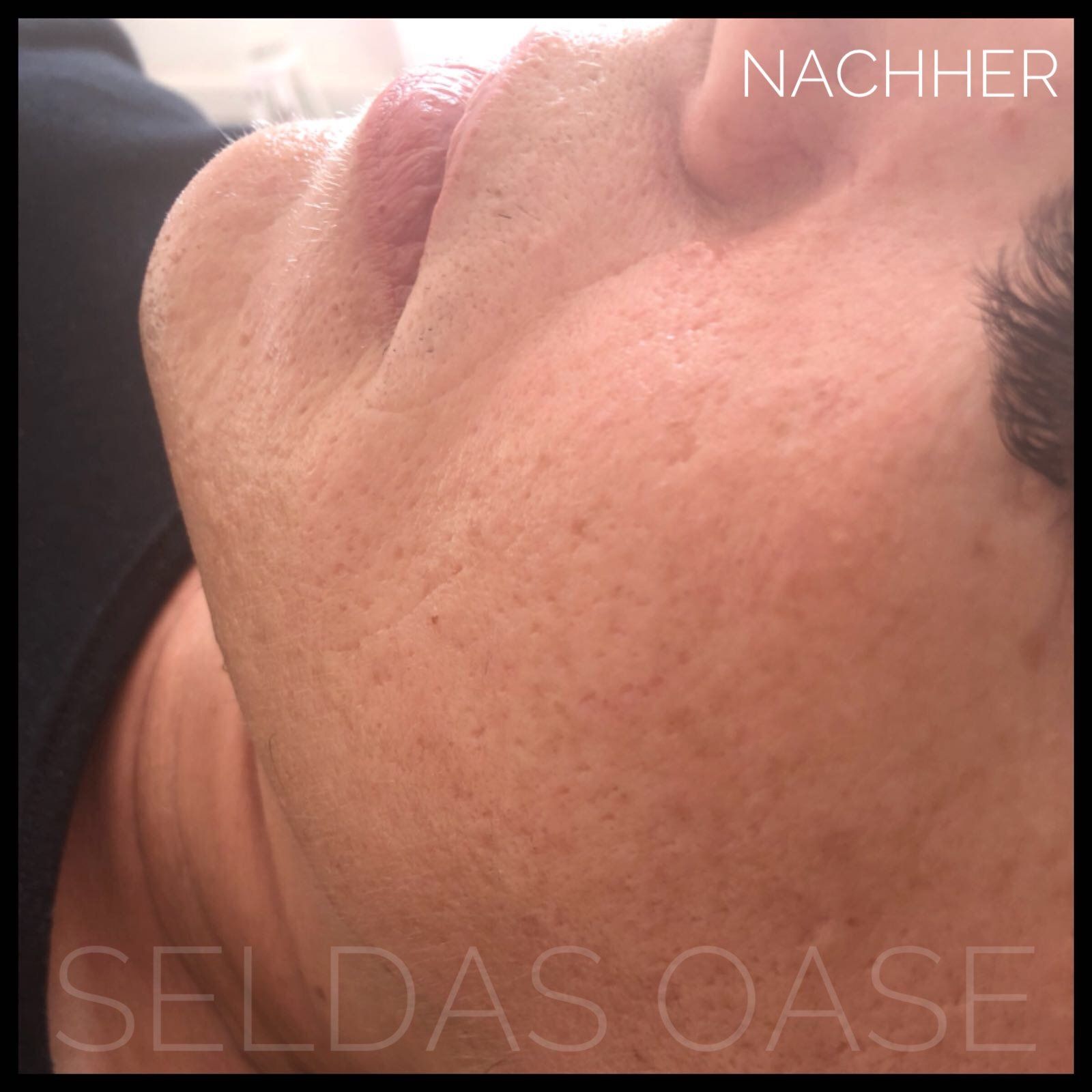 Microneedling Bielefeld Seldas Oase