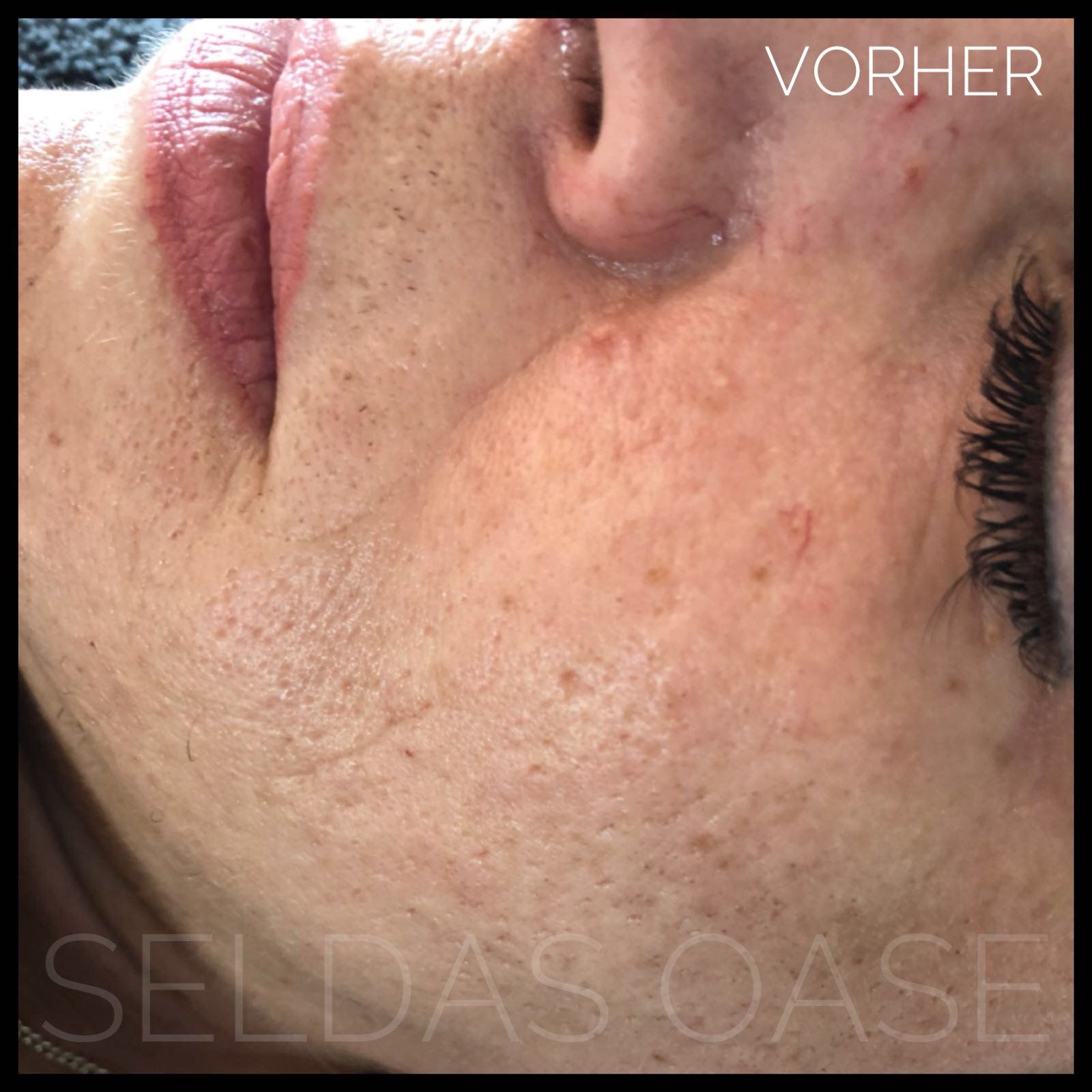 Microneedling Seldas Oase Bielefeld