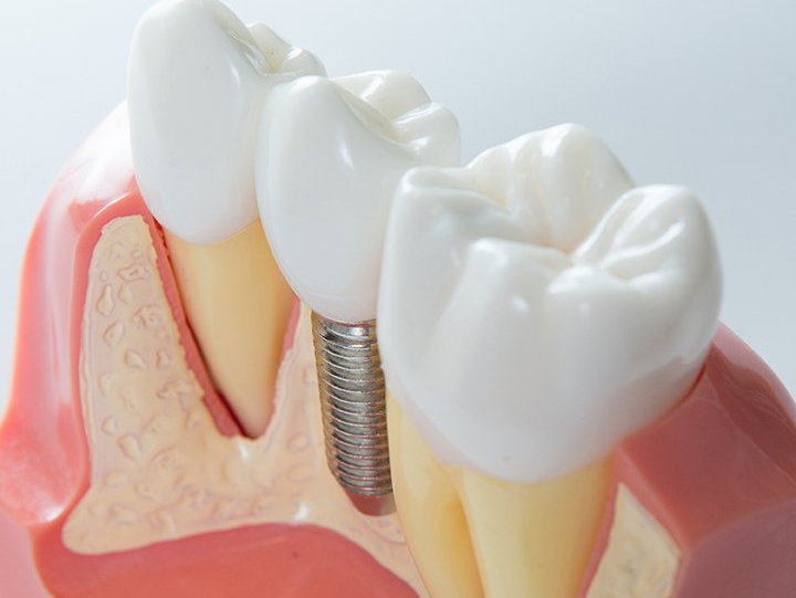 Zahnarzt Fenkl Schweinfurt Gochsheim Implantologie Implantate
