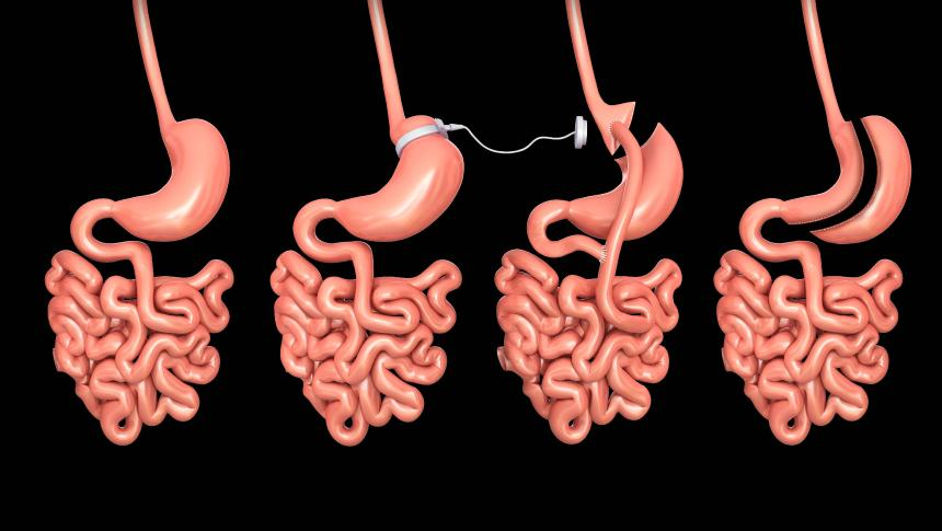 Adipositasoperation Magenbypass Sleeve Schlauchmagen MGB Bariatrie Staikov