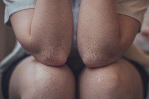 Golfers elbow