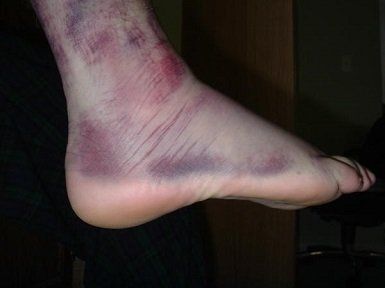 sprain/tear