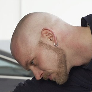 Haarausfall, Behandlung von Haarverlust, Meso Hair Haarausfall, Behandlung von Haarverlust, Meso Hair