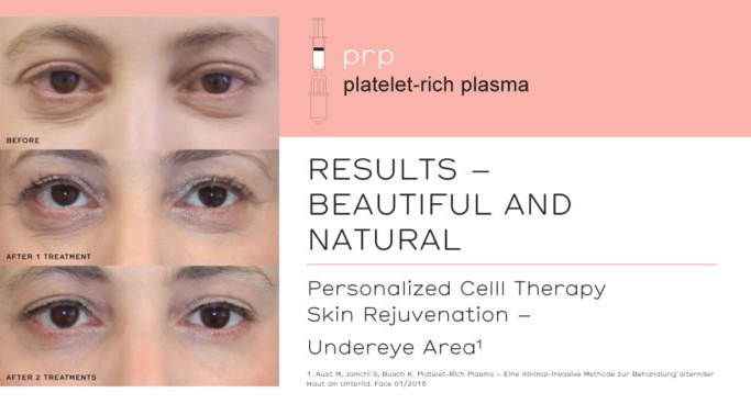 Croma Pharma PRP-Therapie - Vampirlift Augen Croma Pharma PRP Arthrex - Vampire Lift Augen