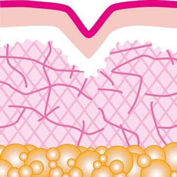 Wir verwenden hauptsächlich die Produkte der Firma Serag-Wiessner, dem Marktführer aus Deutschland. Die PDO-Fäden der Marke Seralea® existieren in verschiedenen Varianten für die speziellen Anwendungsgebiete. Fadenlifting, PDO Fäden, Facelift, Happy Lift, Princess Lift, Brauenlift