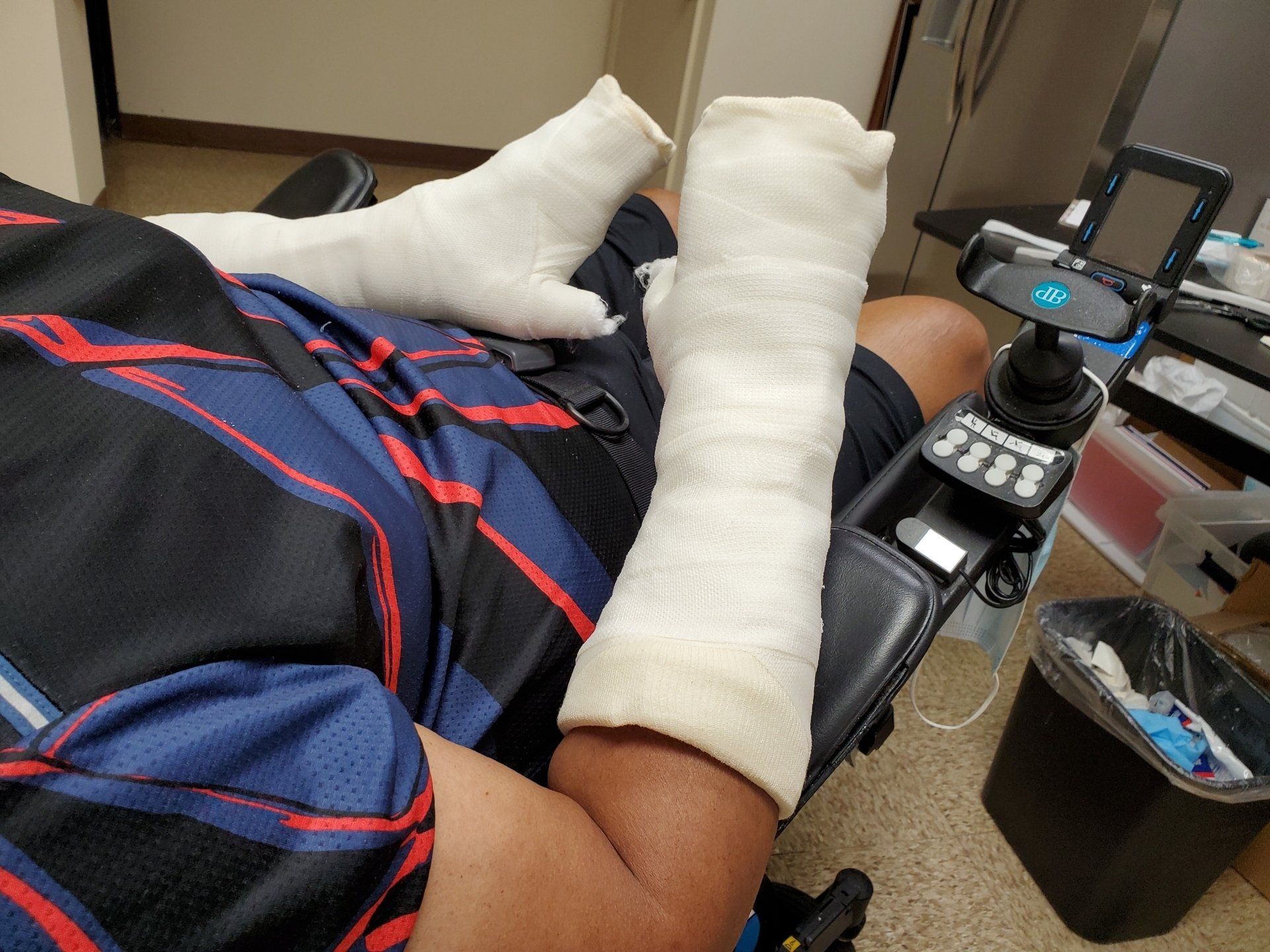 Serial Casting for spasticity after spinal cord injury, brain injury or stroke