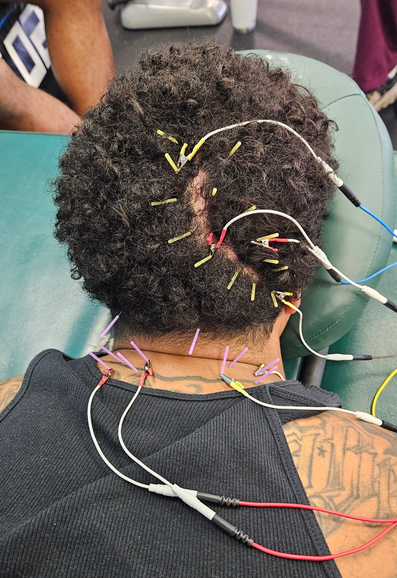 Dry needling scar tissue and muscles after brain injury and stroke