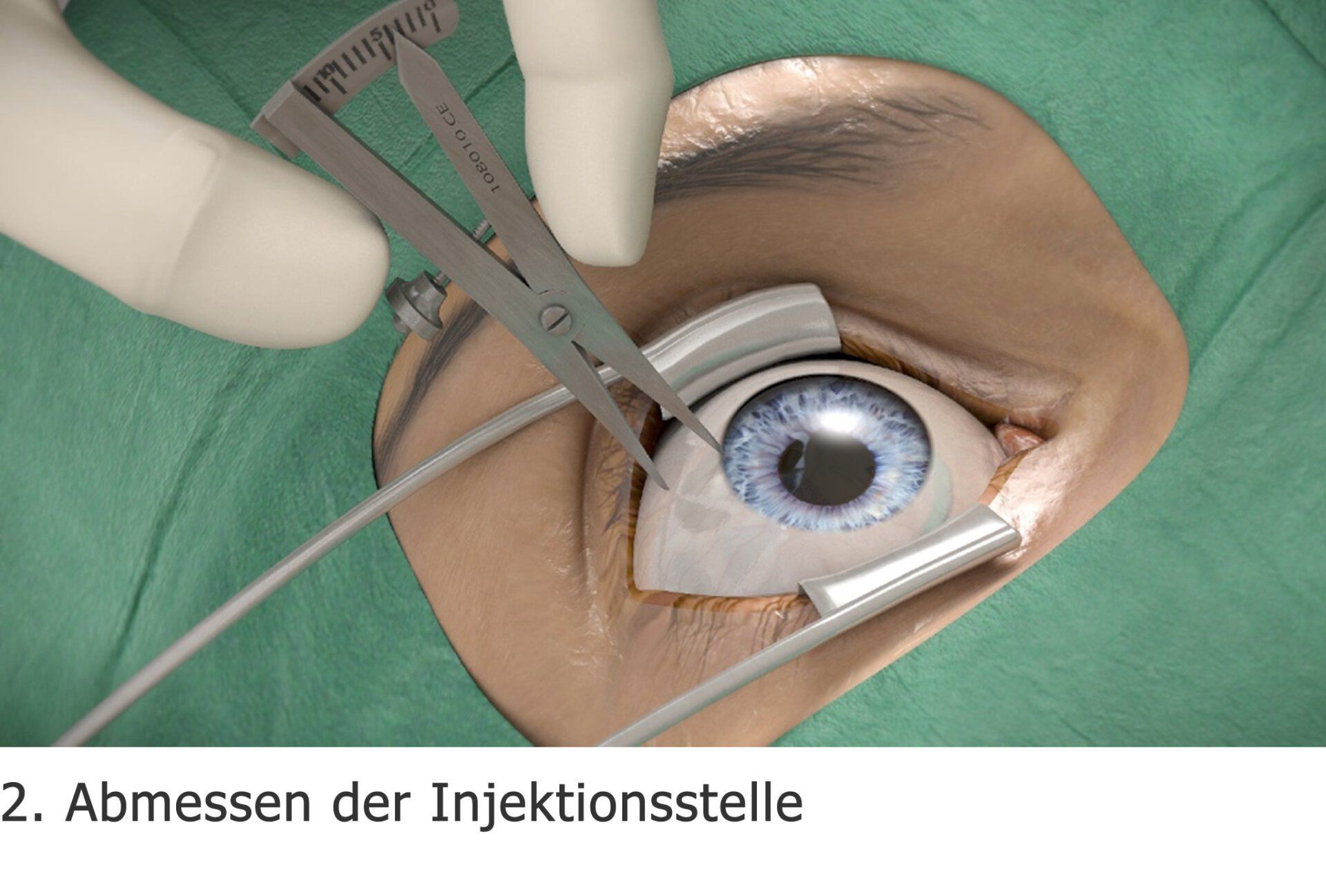 Intravitreale operative Medikamenteneingabe (IVOM) Intravitreale operative Medikamenteneingabe (IVOM)