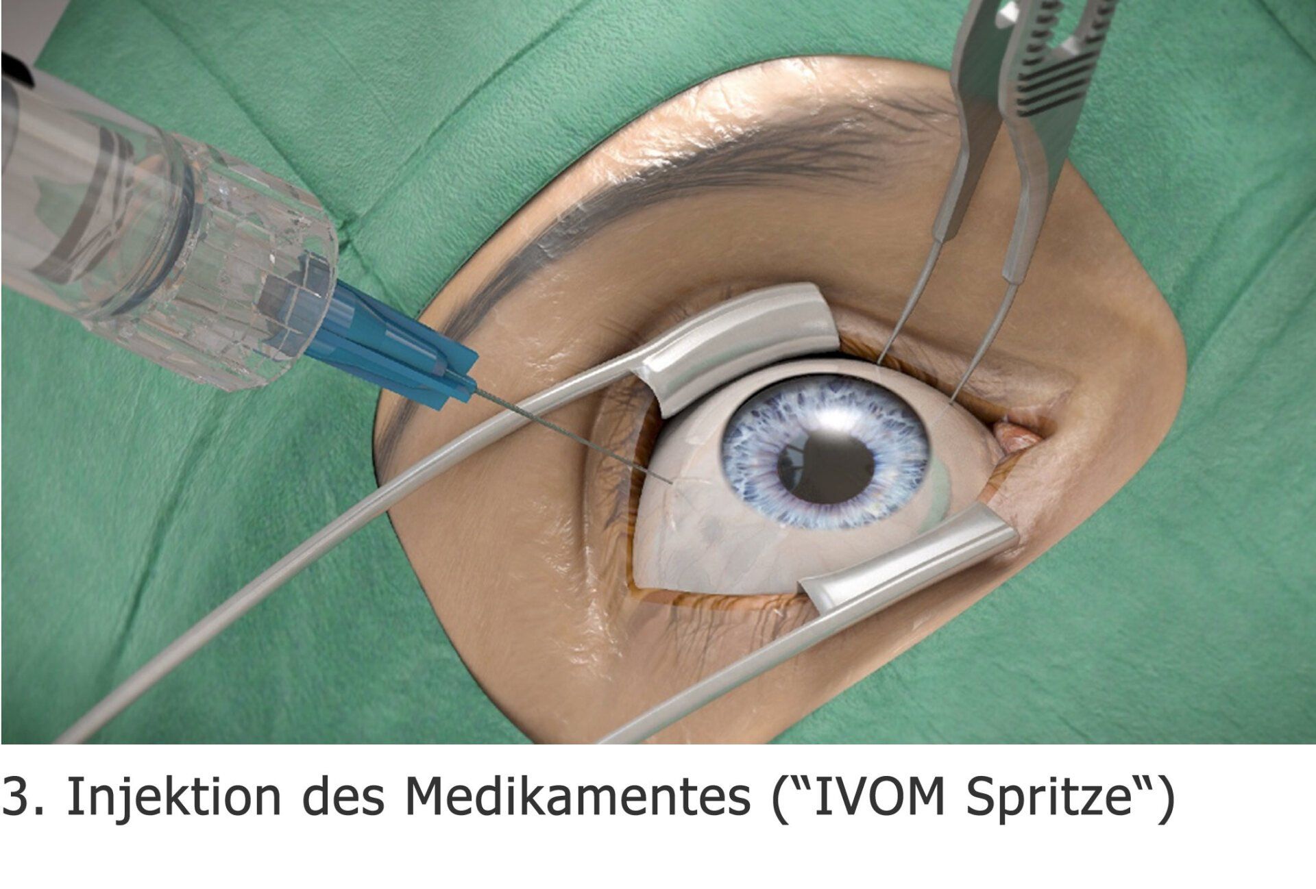 Intravitreale operative Medikamenteneingabe (IVOM) Intravitreale operative Medikamenteneingabe (IVOM)
