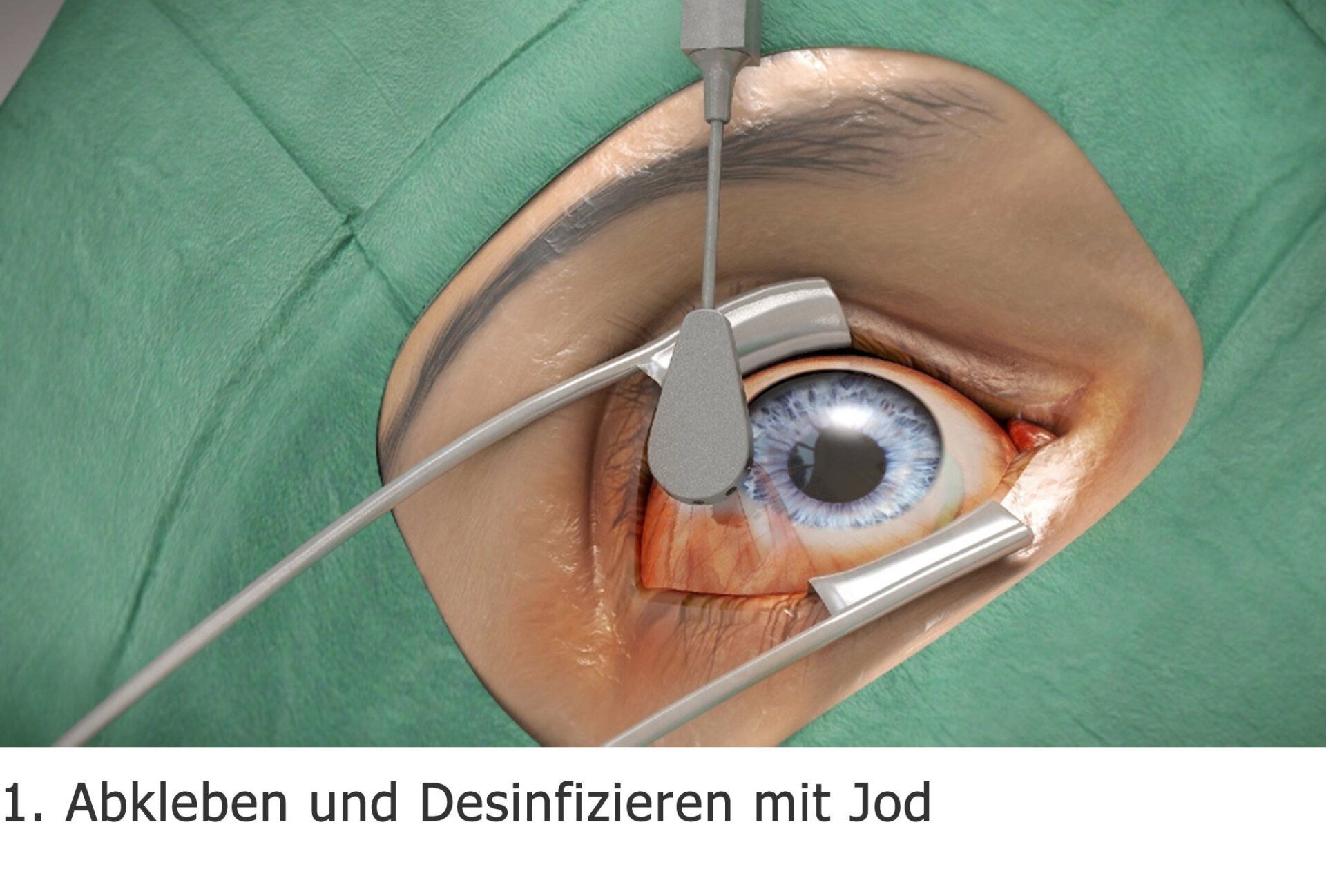 Intravitreale operative Medikamenteneingabe (IVOM) Intravitreale operative Medikamenteneingabe (IVOM)