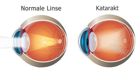 Katarakt (Grauer Star) Katarakt (Grauer Star)