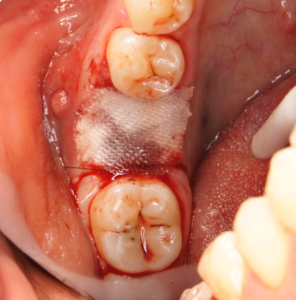 bloodstop, dentingo, bloodstop ix, hämostatikum, matrix, wundheilung, Dental, Dentistry, Zahnarzt, Oralchirurgie, MKG, Extraktion, Sinuslift, Membran,  Implantologie, Osteotomie,