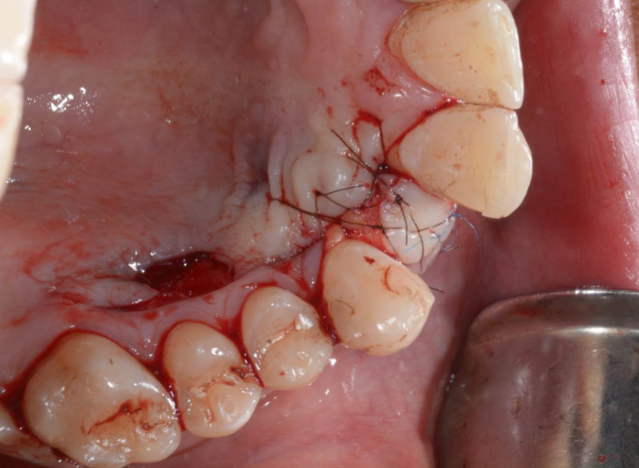 bloodstop, dentingo, bloodstop ix, hämostatikum, matrix, wundheilung, Dental, Dentistry, Zahnarzt, Oralchirurgie, MKG, Extraktion, Sinuslift, Membran, Implantologie, Osteotomie,