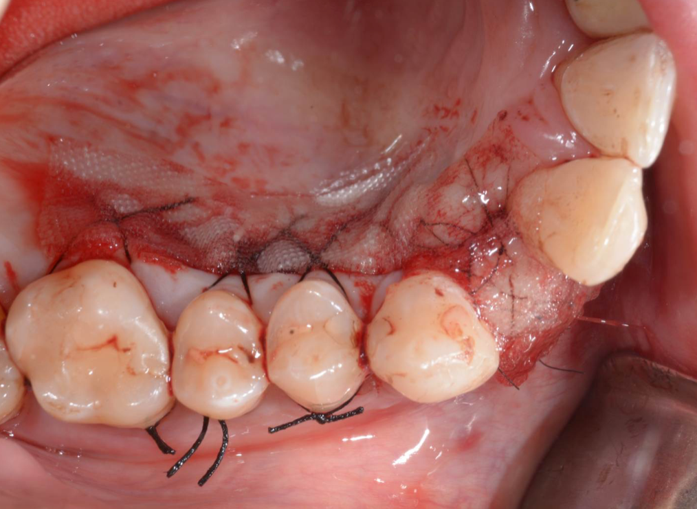 bloodstop, dentingo, bloodstop ix, hämostatikum, matrix, wundheilung, Dental, Dentistry, Zahnarzt, Oralchirurgie, MKG, Extraktion, Sinuslift, Membran, Implantologie, Osteotomie,